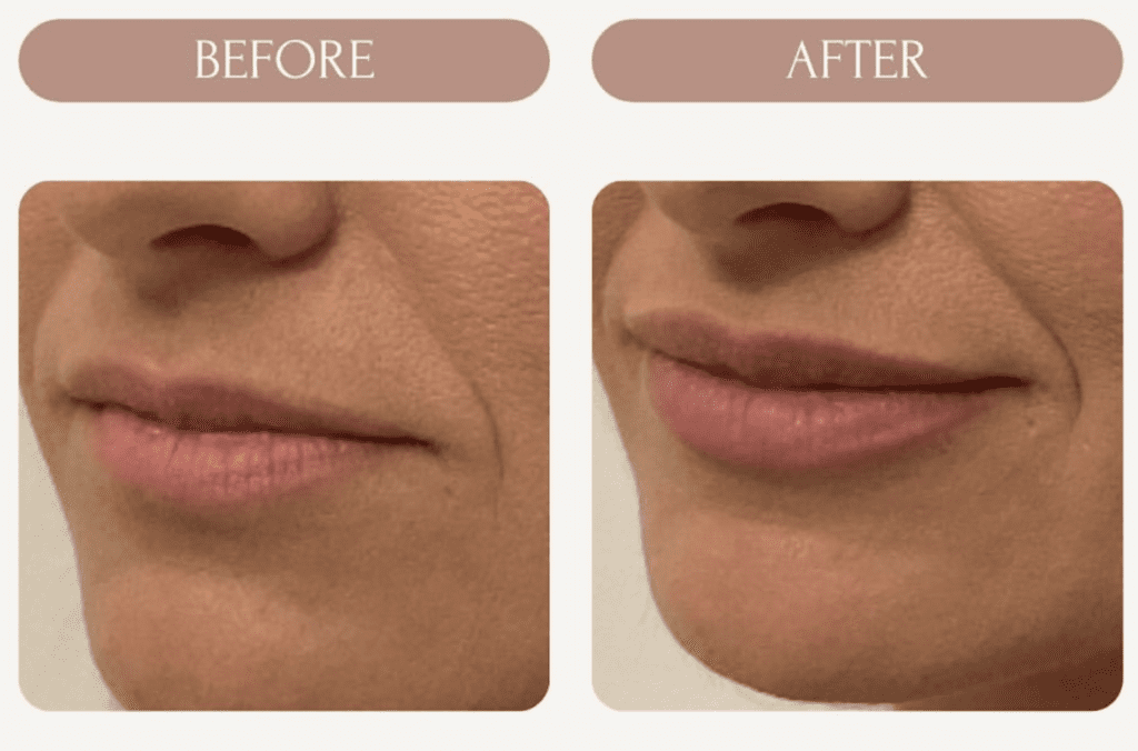 Before and after photo of a woman 's lips