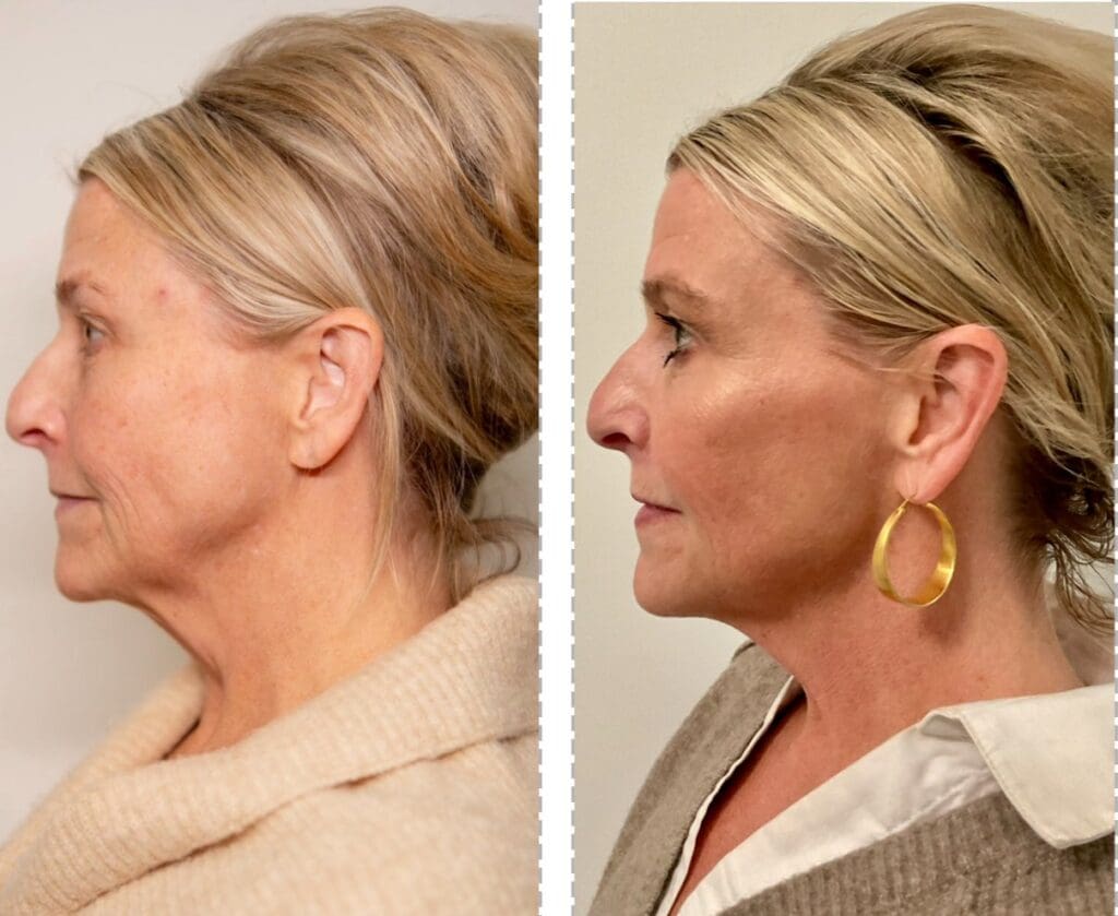 A before and after picture of a woman 's face.