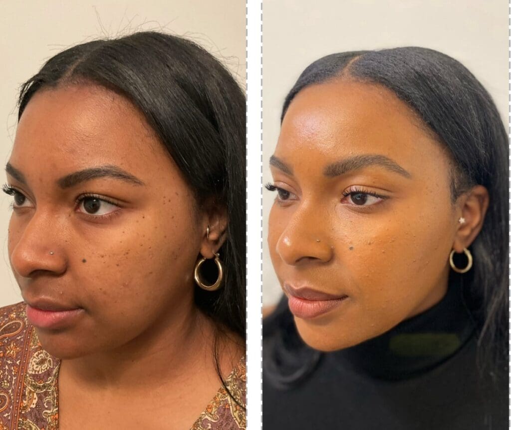 A before and after picture of a woman with acne.