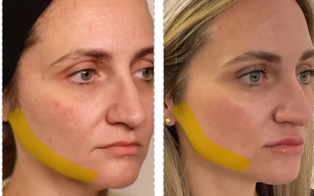 Mid-Face Dermal Filler