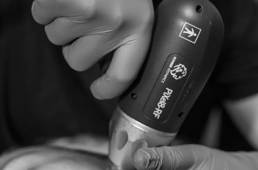 RF Microneedling Benefits and Why Tuscaloosa Loves It