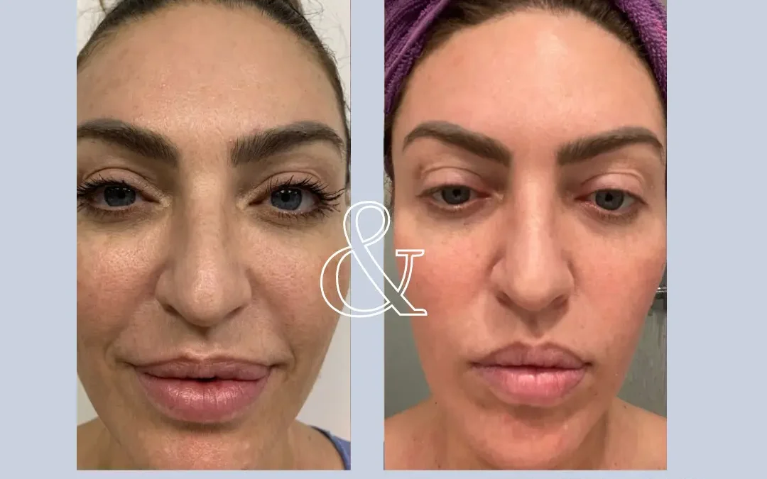 Erbium Laser Skin Resurfacing