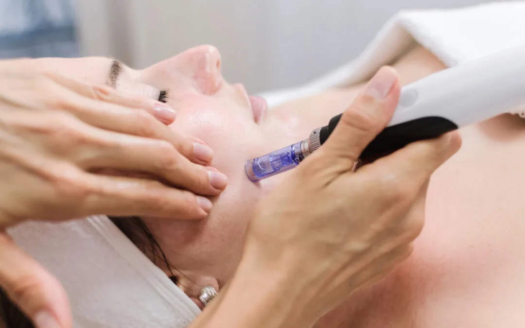 Microneedling
